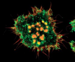 Buňka s podozomy sarkomové linie RsK4 ve fluorescenčním mikroskopu. Podozomy jsou patrné jako žlutooranžově zbarvené útvary ve středu buňky. Jsou to vysoce dynamické cytoskeletární struktury charakterizované přítomností jak F-aktinu (červeně), tak i fosfotyrozinu (zeleně). Foto O. Tolde, z archivu laboratoře J. Brábka, úpravy D. Rösel / © O. Tolde, Archive laboratory J. Brábek