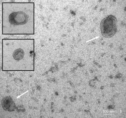 Exozomy produkované buňkami nádoru prsu během kultivace in vitro. V transmisním elektronovém mikroskopu mají typický miskovitý tvar (viz šipky a vložené výřezy). Zvětšení 100 000×. Foto H. Kupcová Skalníková