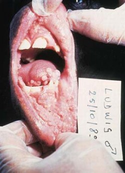 Příčinou onemocnění dutiny ústní - fokální epiteliální hyperplazie u šimpanze je papillomavirus PtPV-1 (Pan troglodytes PV typ 1), který je blízce příbuzný lidskému HPV 13. Foto archiv R. Tachezyové / (c) Photo R. Tachezy