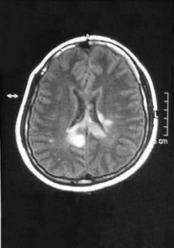 Snímek mozku pacienta s projevy demyelinizačního při roztroušené skleróze mozkomíšní. Vyšetření provedla Klinika zobrazovacích metod 2. LF UK a FN Motol. Foto z archivu M. Bojara / © Klinika zobrazovacích metod 2. LF UK a FN Motol, archive