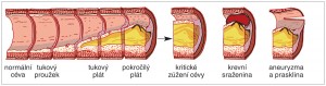 Vývoj aterosklerózy a možné komplikace při pokročilém stadiu onemocnění. Orig. M. Chumchalová, upraveno podle: N. Patchett (2015). Převzato z Wikimedia Commons, v souladu  s podmínkami použití