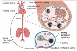 Schéma adaptivní imunity při ateroskleróze: účast buněčné a humorální složky v průběhu rozvoje atero­sklerotického plátu. Blíže v textu. APC (Antigen Presenting Cell) – buňka prezentující antigen; MHC II (Major Histocompatibility Complex II) – hlavní  histokompatibilní komplex II. třídy;  TH1, TH17 – různé populace pomocných T buněk; Treg. – regulační T buňky;  TCR (T-cell Receptor) – T-buněčný receptor.  Orig. M. Chumchalová, upraveno podle: A. Gisterå a G. K. Hansson (2017)