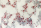 Plicní intersticium (vmezeřená tkáň tvořená řídkým vazivem) při sepsi – cytoplazma buněk zánětu je v řezu  zbarvena červeně imunohistochemickou reakcí prokazující zánětové cytokiny. Zvětšení 200×. Foto I. Trebichavský