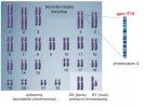 Schéma normálního lidského karyotypu s detailem chromozomu 4, na kterém leží gen IT15. Upraveno podle: Genetics Home Reference, v souladu s podmínkami pro použití (http://ghr.nlm.nih.gov/ handbook/illustrations/normalkaryotype)