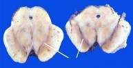 Řez mozkovým kmenem v oblasti středního mozku se znázorněním  substantia nigra – vlevo u Parkinsonovy  choroby, vpravo u zdravého mozku.  Obr. z archivu autora, upraveno
