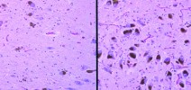 Histologický obraz buněk v substantia nigra ve středním mozku. Vlevo  snížený počet buněk u Parkinsonovy choroby, vpravo normální buňky