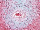 Kolem vajíček schistosom se v játrech tvoří rozsáhlé granulomy vzniklé  nahromaděním imunitních buněk. Vlivem  interleukinu-13 zde také dochází k ukládání kolagenu (modře), což způsobuje fibrózu jaterní tkáně. Foto T. Macháček