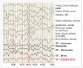 Rok 1616 je jedním z těch, kdy se informace podávané letokruhy dokonale shodují s řečí kronik a jim obdobných záznamů o extrémech klimatu. Letokruhové křivky ukazují nápadnou V-signaturu, která je odpovědí dřevin na nedostatek vláhy ve vegetačním období. ST – standardní chronologie regionů. Orig. J. Kyncl