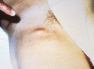 Zduřelá lymfatická uzlina – bubo (hlíza) v třísle pacienta při bubonické formě moru. Snímek se svolením Centre for Disease Control (http://phil.cdc.gov/phil/)