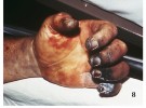 Nekrotická tkáň u oběti moru. Pokud pacient  přežije, nekrotická tkáň prstů se často musí odstraňovat amputací. Snímek se svolením Centre for Disease Control (http://phil.cdc.gov/phil/)
