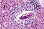 Příklady parazitů, u nichž byl studován vliv na roztroušenou sklerózu. Vajíčka motolice krevničky střevní (Schistosoma mansoni) – řezový histologický preparát, kde kolem vajíčka je patrný infiltrát  imunitních buněk. Foto T. Macháček 