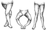 Dolní končetiny rachitických dětí: pokřivené nohy, šavlovité nohy do „O“ a nohy do „X“. Podle Zlaté knihy praktického lékařství domácího Adolfa Ambrože (1936) a Domácí lékařky Jenny Springerové (1925) kreslila M. Chumchalová