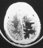 Mozková toxoplazmóza na vyšetření počítačovou tomografií. U HIV pozitivního pacienta s těžkou poruchou imunity, který neužíval antiretrovirovou terapii, náhle došlo k rychlému rozvoji těžké poruchy hybnosti pravé horní i dolní končetiny. Na vyšetření hlavy počítačovou tomografií je v levé týlní oblasti mozku patrné rozsáhlé nekrotické ložisko (označeno bílou šipkou) obklopené zónou výrazného otoku mozkové tkáně. Snímek byl zhotoven Radiodiagnostickou klinikou Fakultní nemocnice Bulovka
