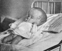 Dítě s hydrocefalem způsobeným toxoplazmózou. Vyobrazení z článku J. Janků v Časopise lékařův českých (1923)