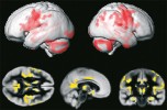 Je známo, že mozky pacientů  se schizofrenií vykazují v určitých oblastech nižší hustotu šedé hmoty mozkové (na snímcích z magnetické rezonance červeně nebo žlutě). Z našich výsledků však vyplývá, že tato učebnicová pravda platí pouze pro pacienty, kteří jsou zároveň nakaženi toxoplazmou. Horáček a kol. 2012, s laskavým svolením autora