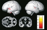 Je známo, že mozky pacientů  se schizofrenií vykazují v určitých oblastech nižší hustotu šedé hmoty mozkové. Z našich výsledků však vyplývá, že tato učebnicová pravda platí pouze pro pacienty, kteří jsou zároveň nakaženi toxoplazmou. Mozky schizofreniků bez infekce se od mozků zdravých kontrolních jedinců prakticky neliší (viz obr.) a stejně tak se neliší mozky nakažených a nenakažených kontrolních osob. Orig. J. Horáček, s laskavým svolením autora