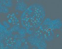 T lymfocyty infikované HIV  (snímek z prozařovacího elektronového mikroskopu, počítačově obarveno).  Foto F. Weyda (z článku M. Brůčkové v Živě 2003, 5: 194–196)