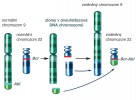 Chromozomové změny vedoucí k chronické myeloidní leukémii. Díky chromozomové přestavbě se do vzájemné blízkosti dostávají geny, které se původně nacházely na různých chromozomech. Nové spojení vede ke změně produkce obou proteinů a jejich umístění v buňce. Výsledkem je v tomto případě nádorový fenotyp postižených buněk. Podle různých zdrojů kreslila M. Chumchalová