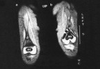 Zobrazení osifikačních jader a růstové chrupavky v oblasti epifýzy distálního femuru magnetickou rezonancí (kostní tkáň černě, chrupavka bíle). Situace anatomická (a), a zřetelná deformace osifikačního jádra a růstové chrupavky (b). Vytvořil se kostní můstek (šipky), který způsobuje zkrácení kosti; oc – osifikační centrum, d – diafýza femuru