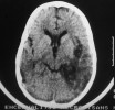  Na snímku provedeném počítačovou tomografií je v pravé polovině mozku rozsáhlé ložisko nekrózy, způsobené HSV-1. Herpetická hemoragicko-nekrotická encefalitida je naštěstí vzácné, ale velmi těžké onemocnění ohrožující život. Včasné nitrožilní podání vysokých dávek virostatika je rozhodující  pro přežití pacienta a prevenci vzniku  trvalých psychomotorických následků.  Foto z archivu Radiodiagnostické kliniky Nemocnice Na Bulovce 