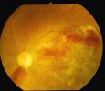 Oční pozadí HIV pozitivního pacienta s cytomegalovirovým zánětem sítnice. Onemocnění se vyskytuje při závažné poruše imunity a může vést až ke slepotě. Jedinou šancí, jak proces zastavit a zacho­vat alespoň zbytky zraku, je včasné zahájení virostatické léčby, v tomto případě ganciklovirem. Žlutavá barva odpovídá zónám nekrózy sítnice, červeně místa krvácení. V angličtině jsou změny na očním pozadí poeticky nazývány cottage cheese and catchup spots. Foto J. Hynie, Oční oddělení Nemocnice Na Bulovce
